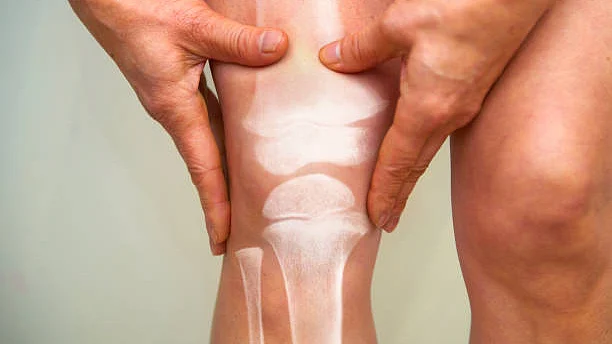 Covid can induce severe inflammatory bone loss: Study