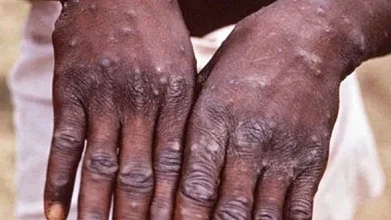 Canada confirms 58 cases of monkeypox