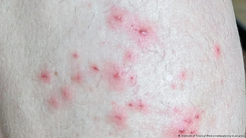 Monkeypox