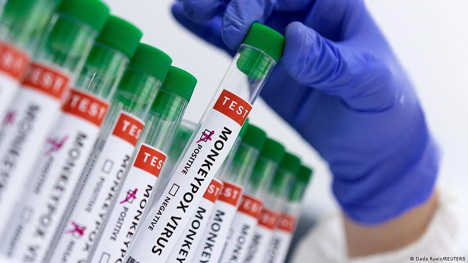 Current monkeypox symptoms different from previous outbreaks: BMJ study
