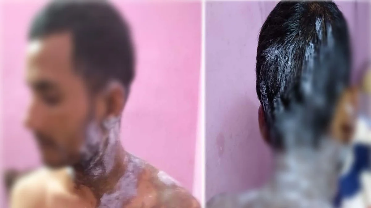 उत्तर प्रदेश: उन्नाव में एकतरफा प्यार में युवती ने लड़के पर फेंका तेजाब, गंभीर हालात में अस्पताल में भर्ती
