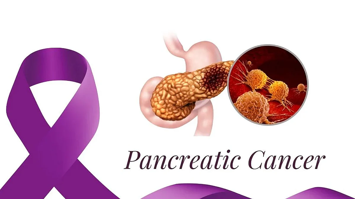 A trial on the vaccine for preventing pancreatic cancer