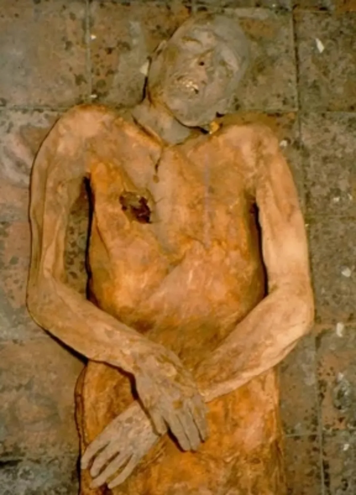 A 16th-century mummy's gallstone was used to rebuild the ancient genome of E. coli