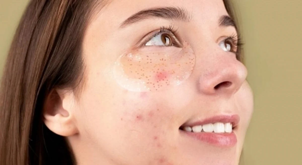 How to prevent an acne breakout before your period