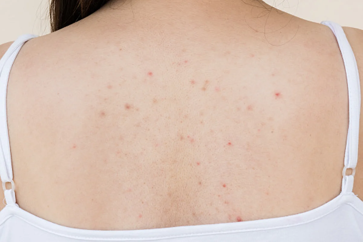 Body acne (Pixabay)