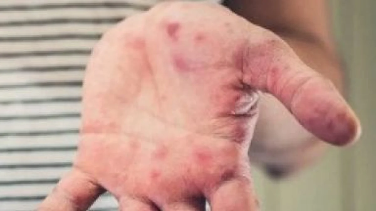 Though the tomato flu disease is not seen as life-threatening, healthcare experts have warned that any further spread of the disease may hit school attendance.