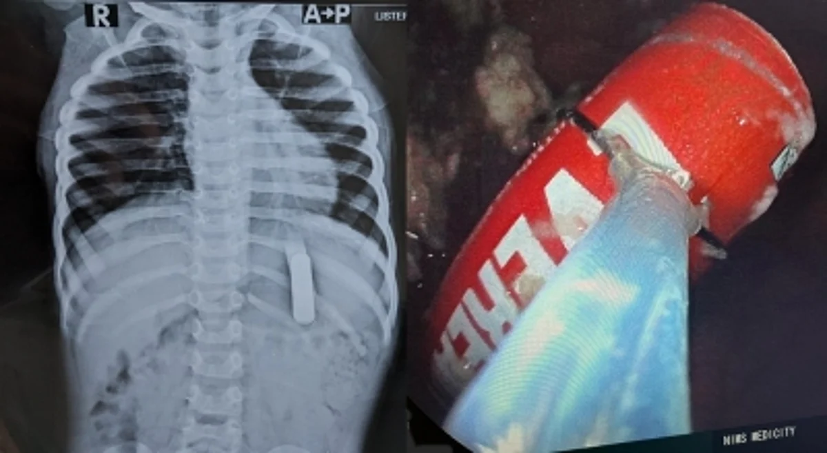 A Medical intervention successfully took out a battery and saved the life of a two-year-old boy. (IANS)