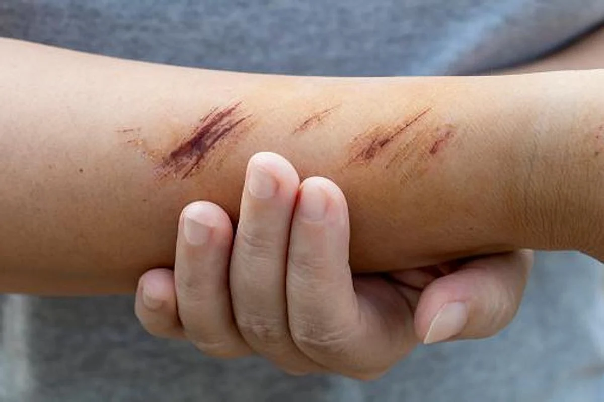 Scientists have found a cure for those suffering from diabetic foot ulcers.