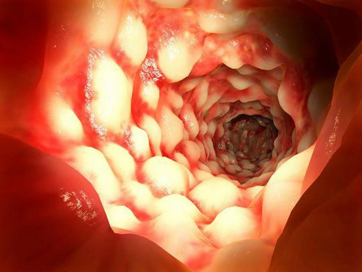 Researchers Discover Novel Potential Therapy For Children Diagnosed With Crohn’s Disease