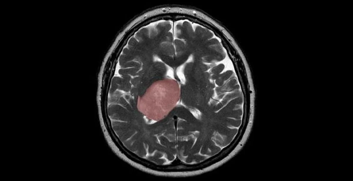 Common Parasite In Uncooked Food May Cause Brain Cancer