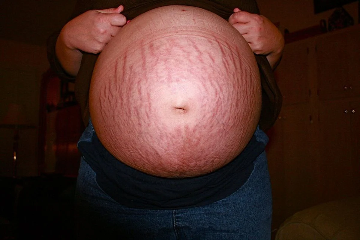 Here’s How You Can Prevent Stretch Marks During Pregnancy