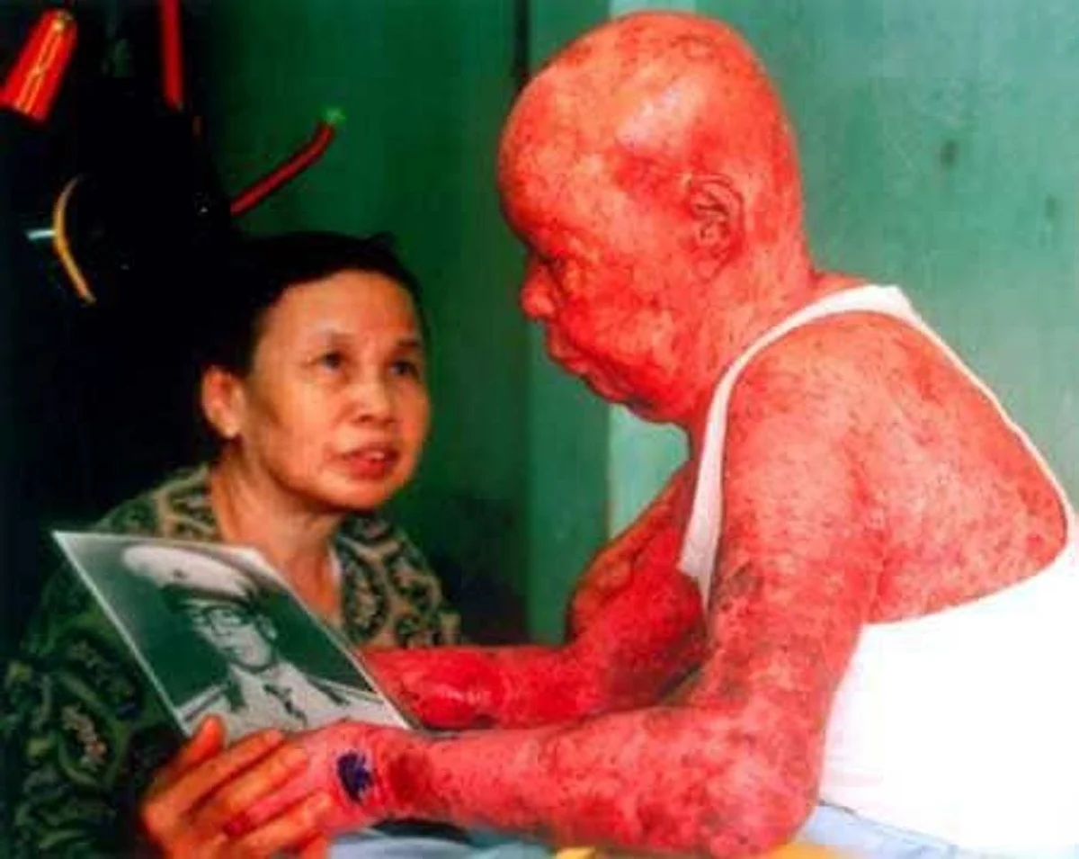 Agent Orange 40 Years After The Vietnam War The Ghosts Of Chemical Warfare Live On Agent Orange 40 Years After The Vietnam War The Ghosts Of Chemical Warfare Live On