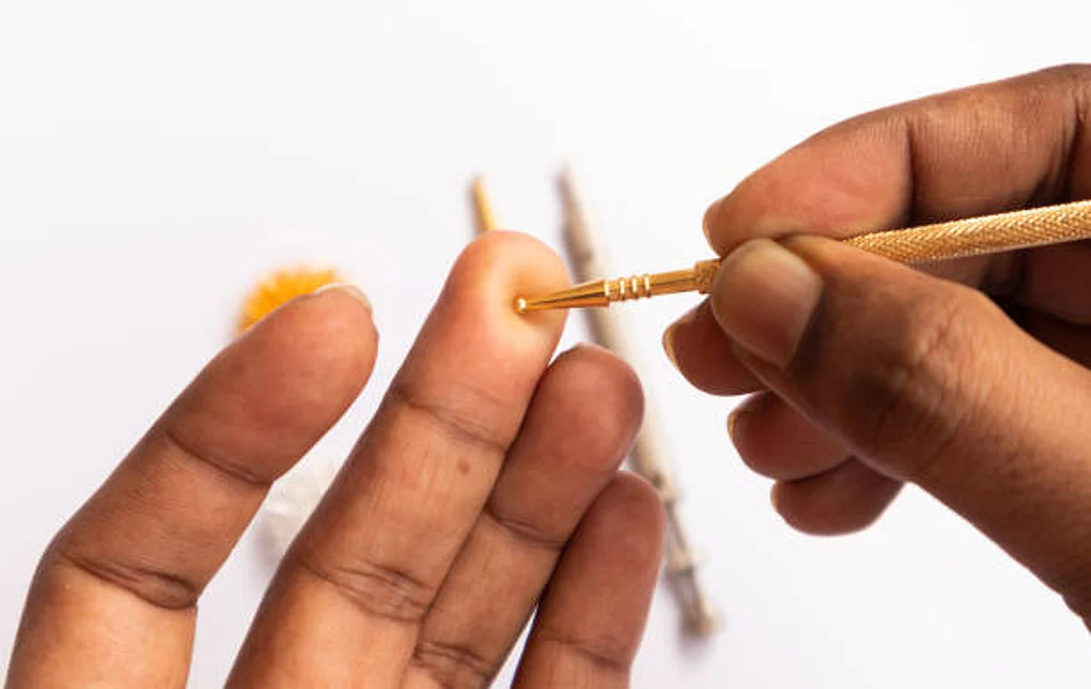 The need to recover from a rather painful medical condition took her to acupuncture.(Unsplash)