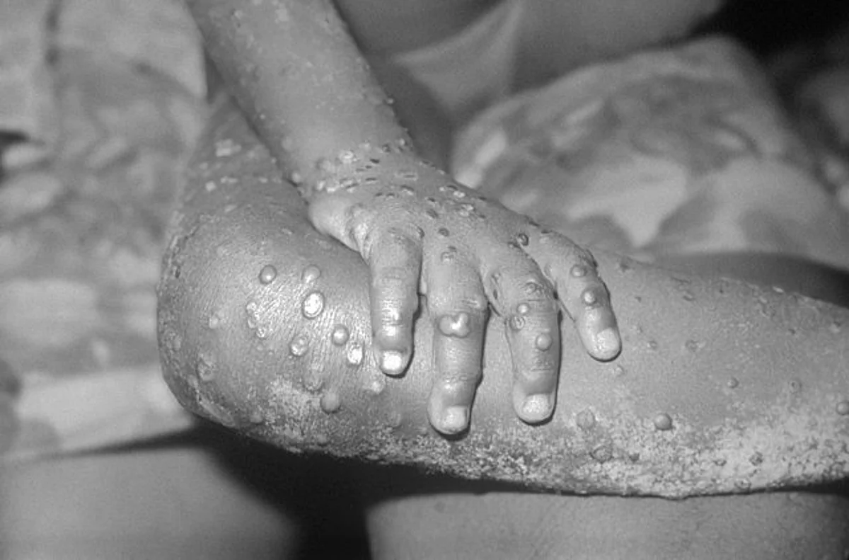 सेक्स के जरिए फैल रहा Monkeypox Virus
