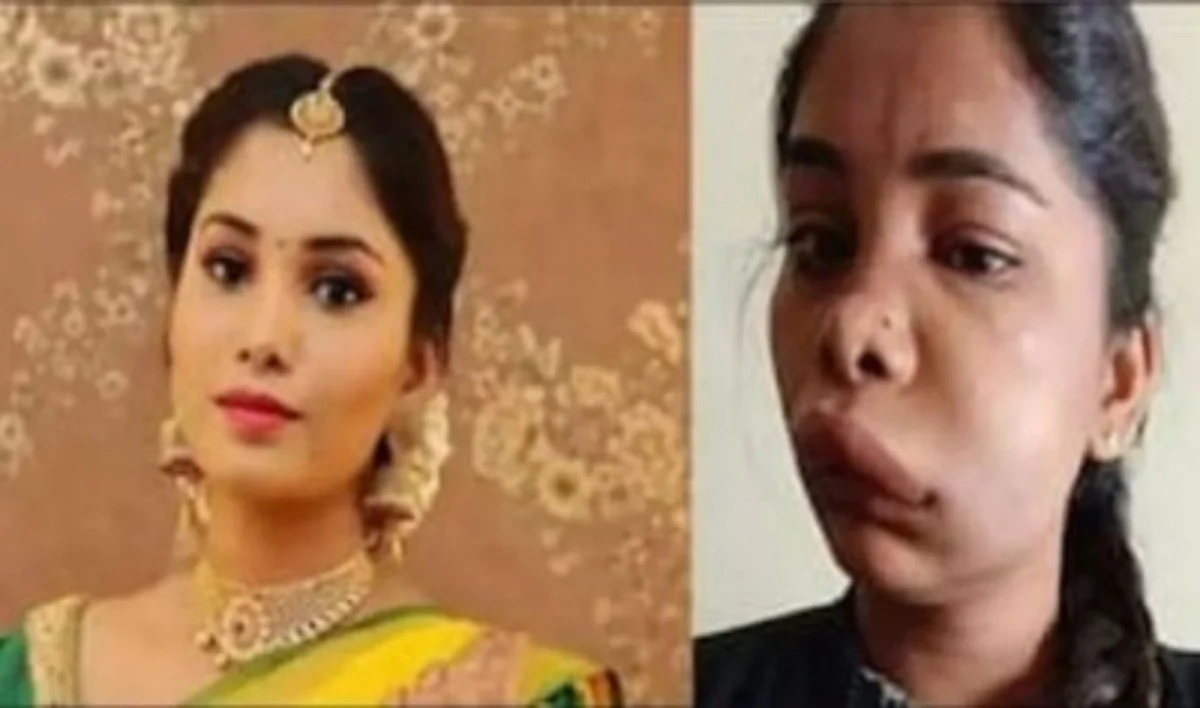 कन्नड़ अभिनेत्री का चेहरा Root Canal Surgery के बाद सूजा
