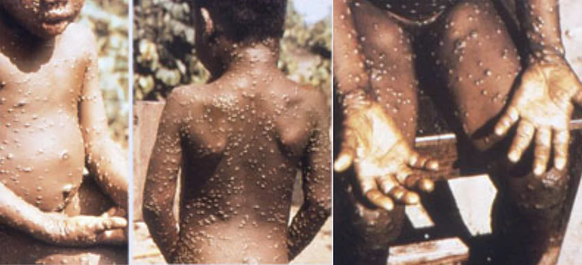 MonkeyPox केवल 'निरंतर' आमने-सामने संपर्क के दौरान हवा से फैलता है: सीडीसी