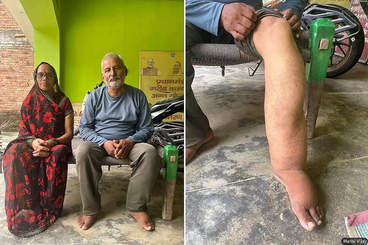 Mahendra Singh, 60, says he feels no pain in his lymphoedema. His wife, Uma reveals he suffers from “latakne wali” (scrotal hydrocele) and regular acute attack fevers.