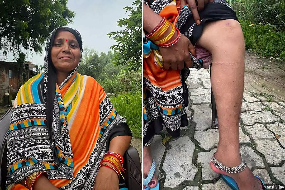 Bitto Devi, 40, from Sadhamau, shows the scars around her lymphoedema, worsened by years of local treatments. Her legs would ache and swell from a day spent squatting in the fields, eventually forcing her to quit work as a farm labourer.