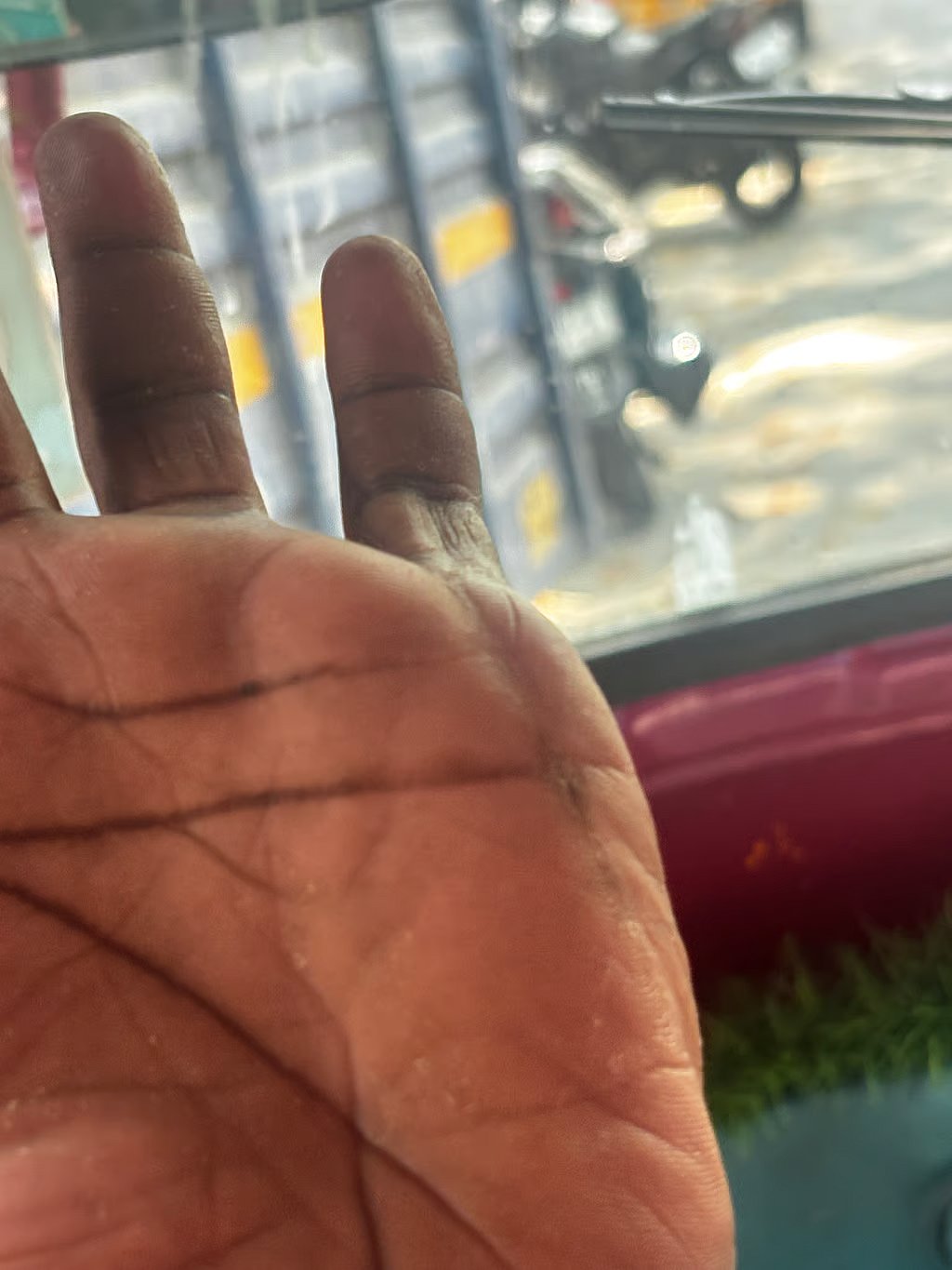 Autorickshaw driver S Iyappan shows a scar on his palm from a recent altercation.