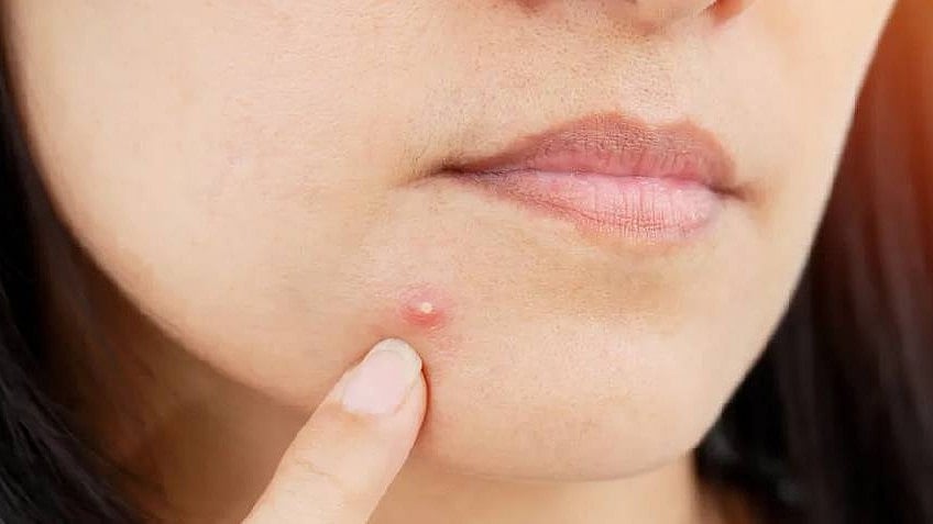 பதின் பருவத்தில் வரக்கூடிய பருக்களை தடுக்க 4 எளிய வழிகள் இதோ!