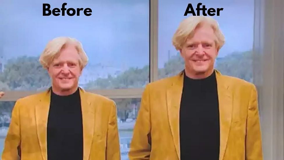 உயரமாக அறுவை சிகிச்சை செய்துக்கொண்ட நபர் : 1.2 கோடி செலவில் சிகிச்சை - எங்கே?