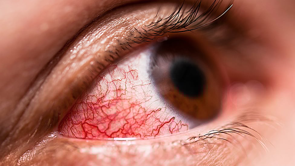 மெட்ராஸ் ஐ : வேகமாக பரவிவரும் வைரஸ் தொற்று - நம்மை காத்துக்கொள்வது எப்படி?