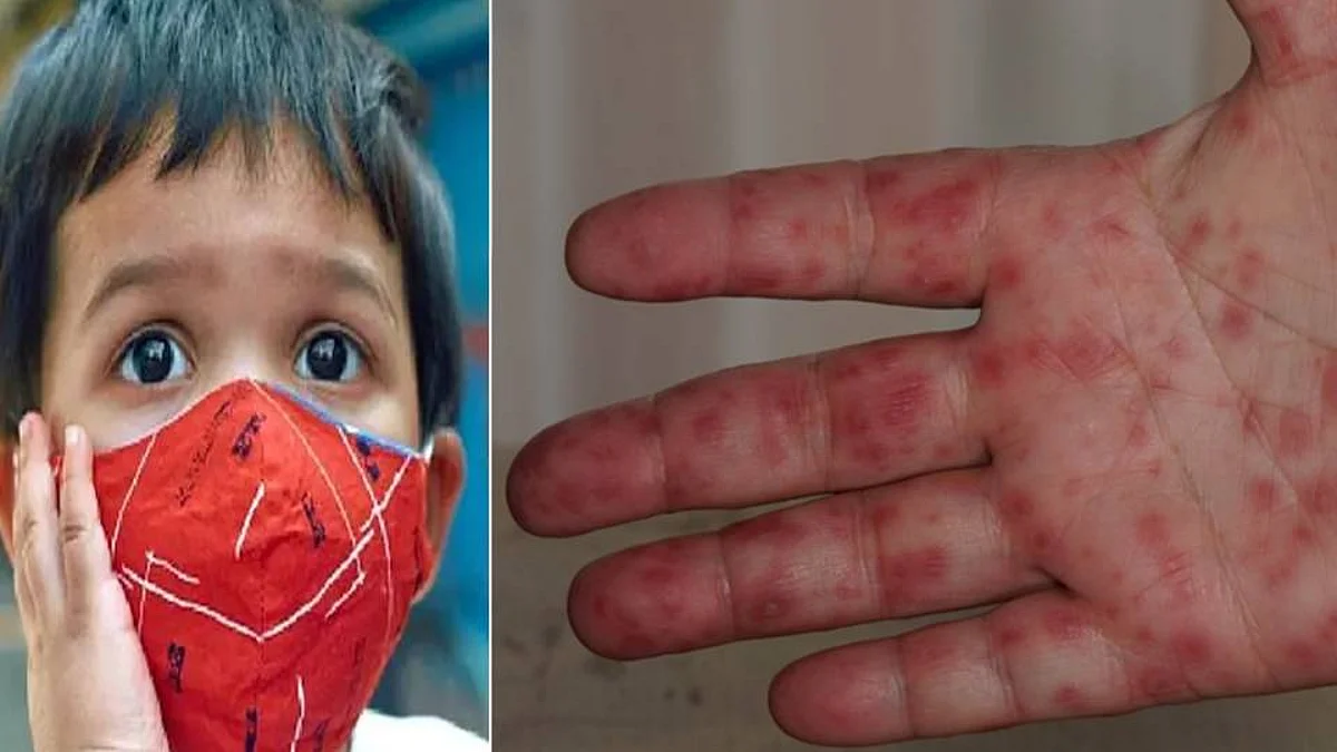Tomato Flu: কেরালায় ‘টম্যাটো ফ্লু’ নামক অজানা জ্বরে আক্রান্ত ৮০ জন শিশু, কী বলছেন চিকিৎসকরা?