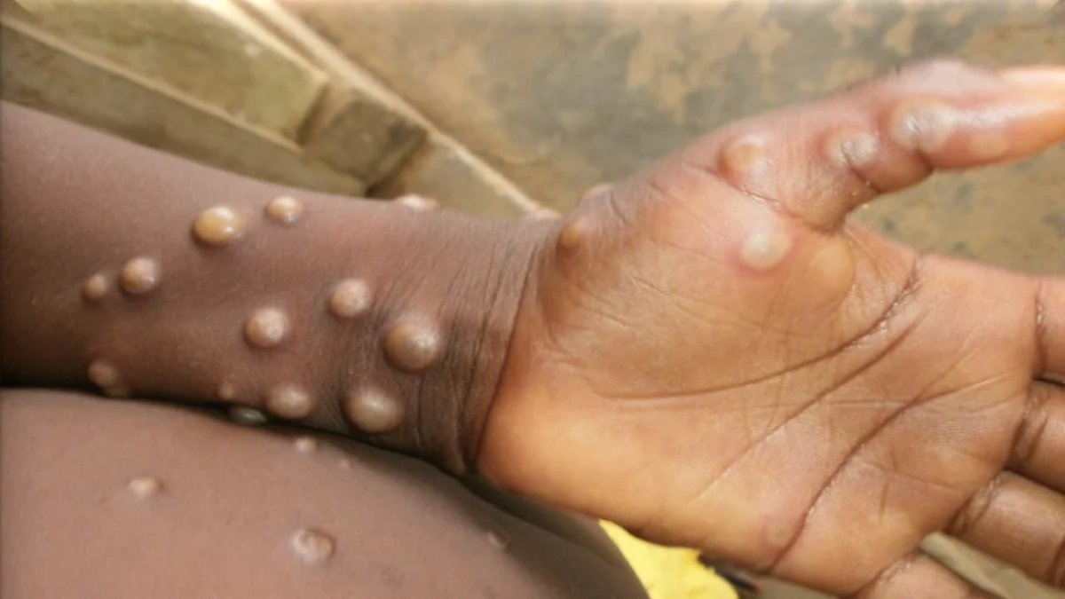 Monkeypox: কোভিডের পাশাপাশি এবার আতঙ্ক ছড়াচ্ছে 'মাঙ্কি পক্স' - কী বলছেন বিশেষজ্ঞরা!