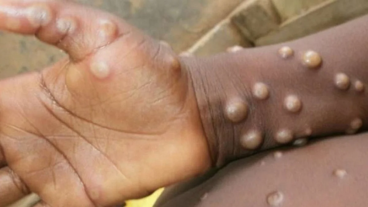 550 Cases of Monkeypox Reported across 30 Countries