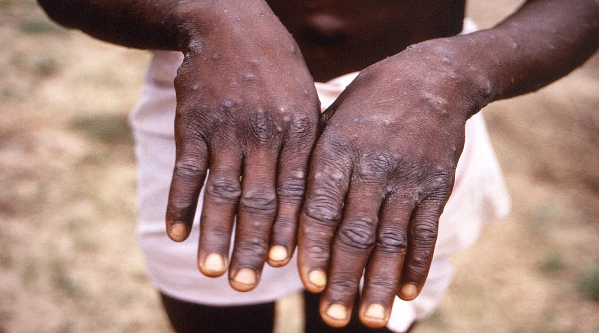 WHO Confirms 80 Cases of MonkeyPox in 11 Countries
