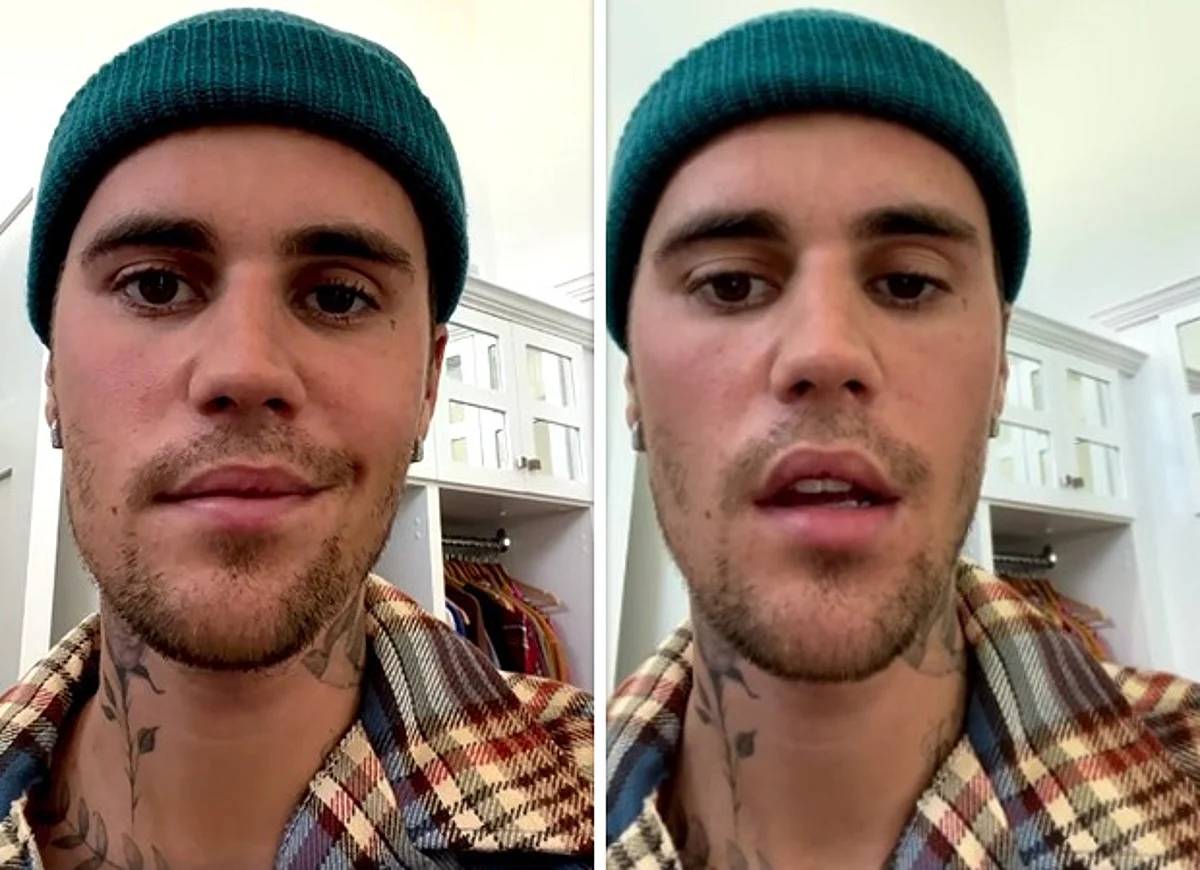 Pop Star Justin Bieber Suffers from Facial Paralyses