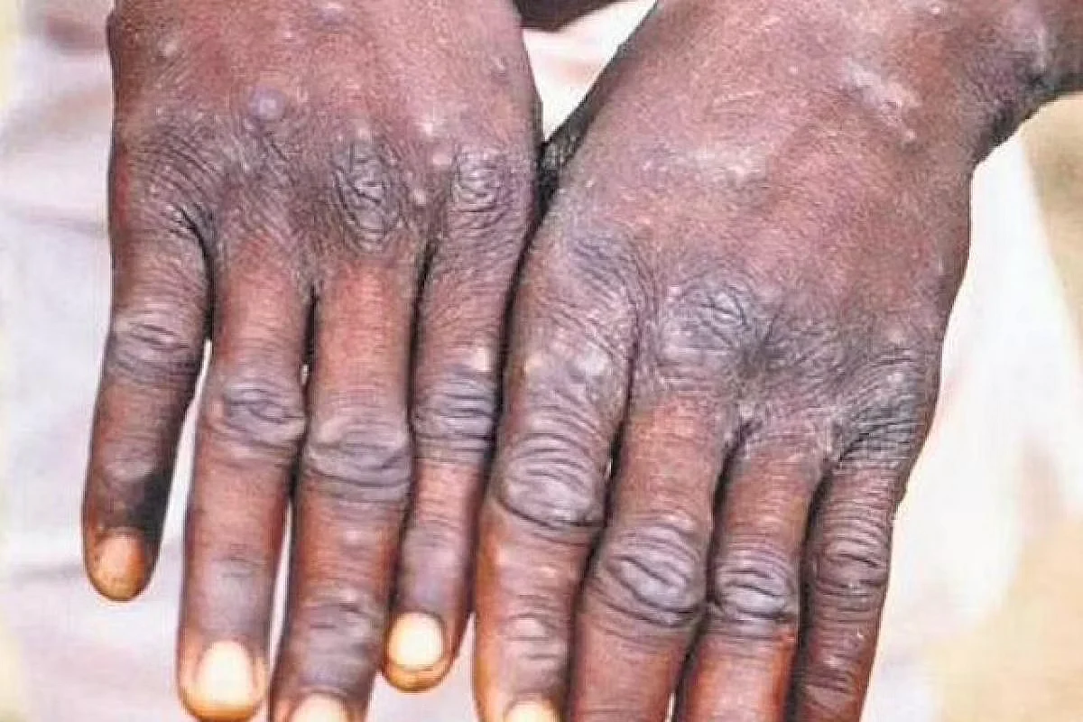 India's First Monkeypox Case Detected In Kerala