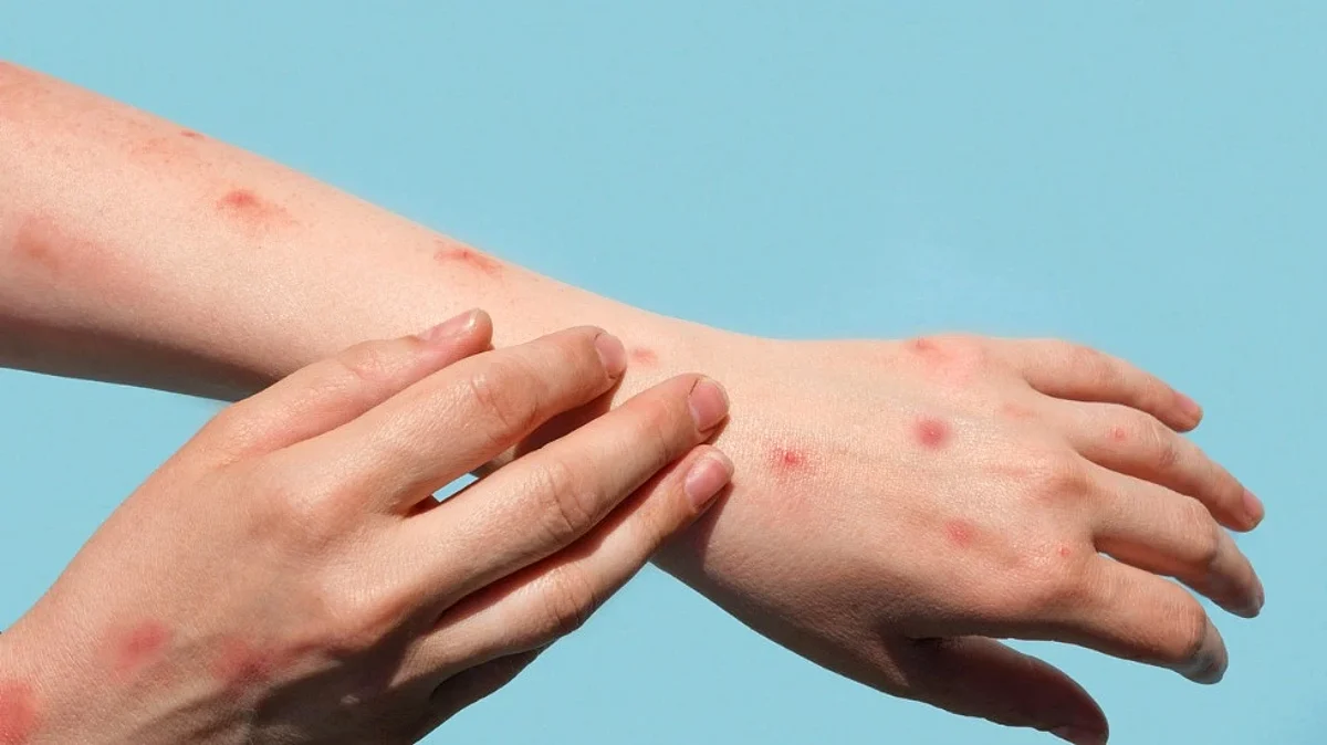 USA declares Monkeypox as health emergency (Representative image)