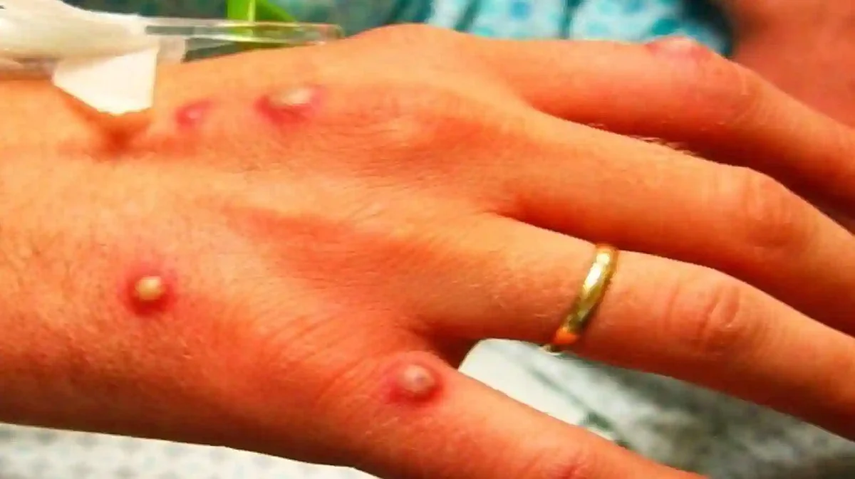 Another Case of Monkeypox Reported in Delhi