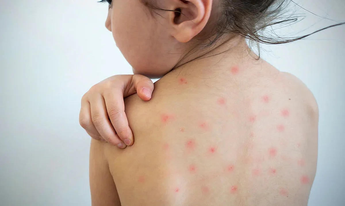 The measles outbreak in Mumbai is turning worse
