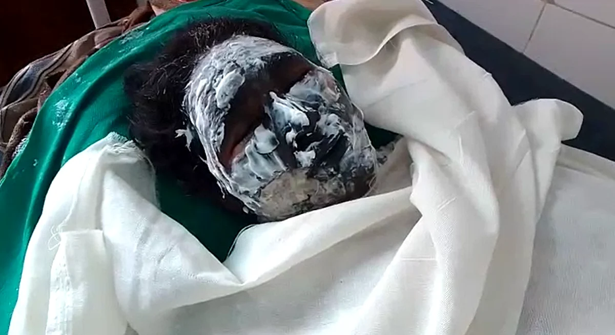 नशे के गुलाम ने अपने ही घर में लगाई आग, मासूम नाती संग पत्नी, बेटा व गर्भवती बेटी झुलसी