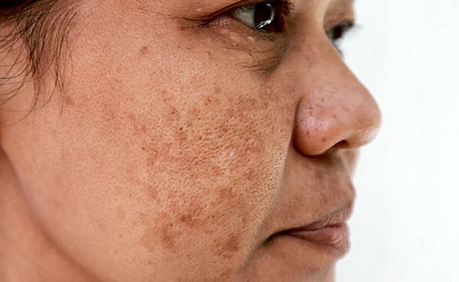 sk90el48hyperpigmentation home