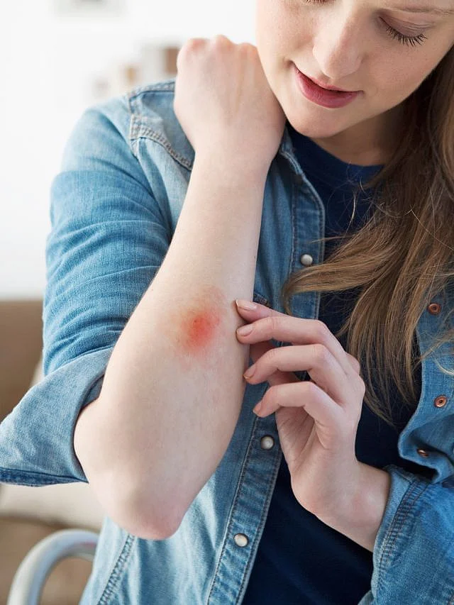 diwali fireworks skin burn reduce home remedies