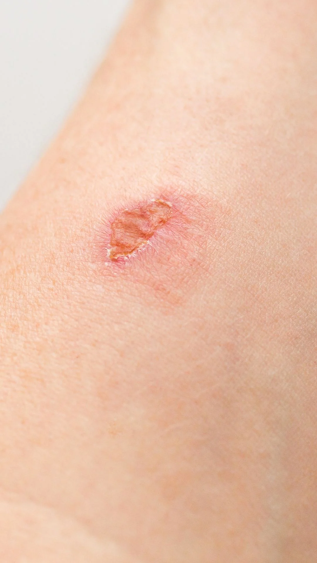 skin burn