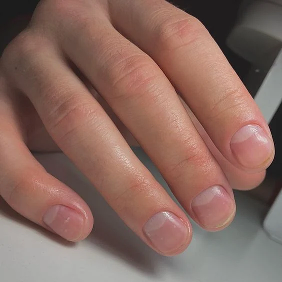 unhelathy nails