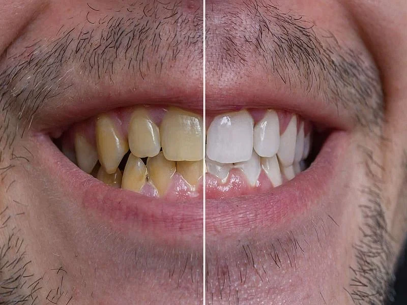 teeth whitening remedies202101198544