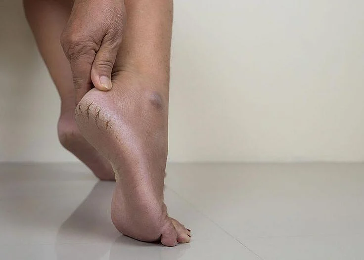 cracked heels