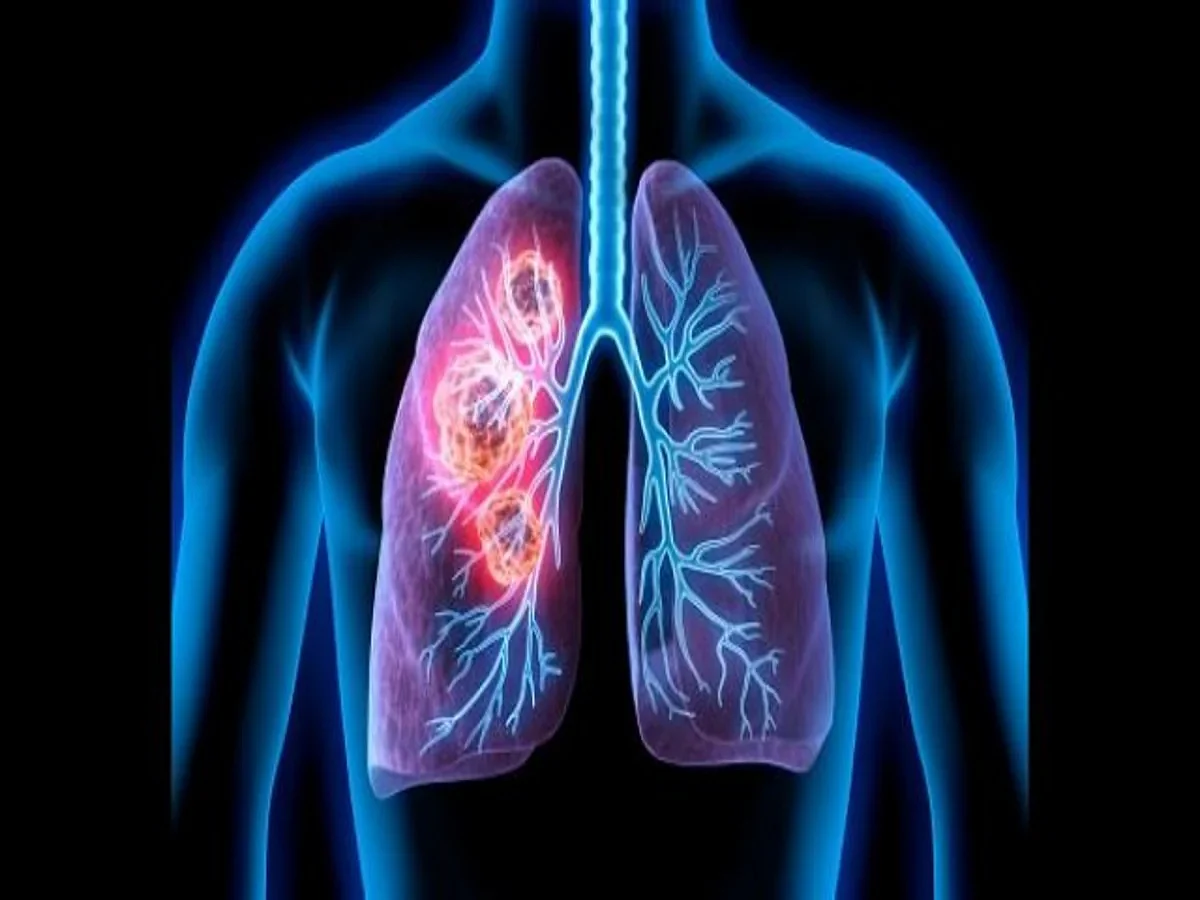 lungcancer1597208810