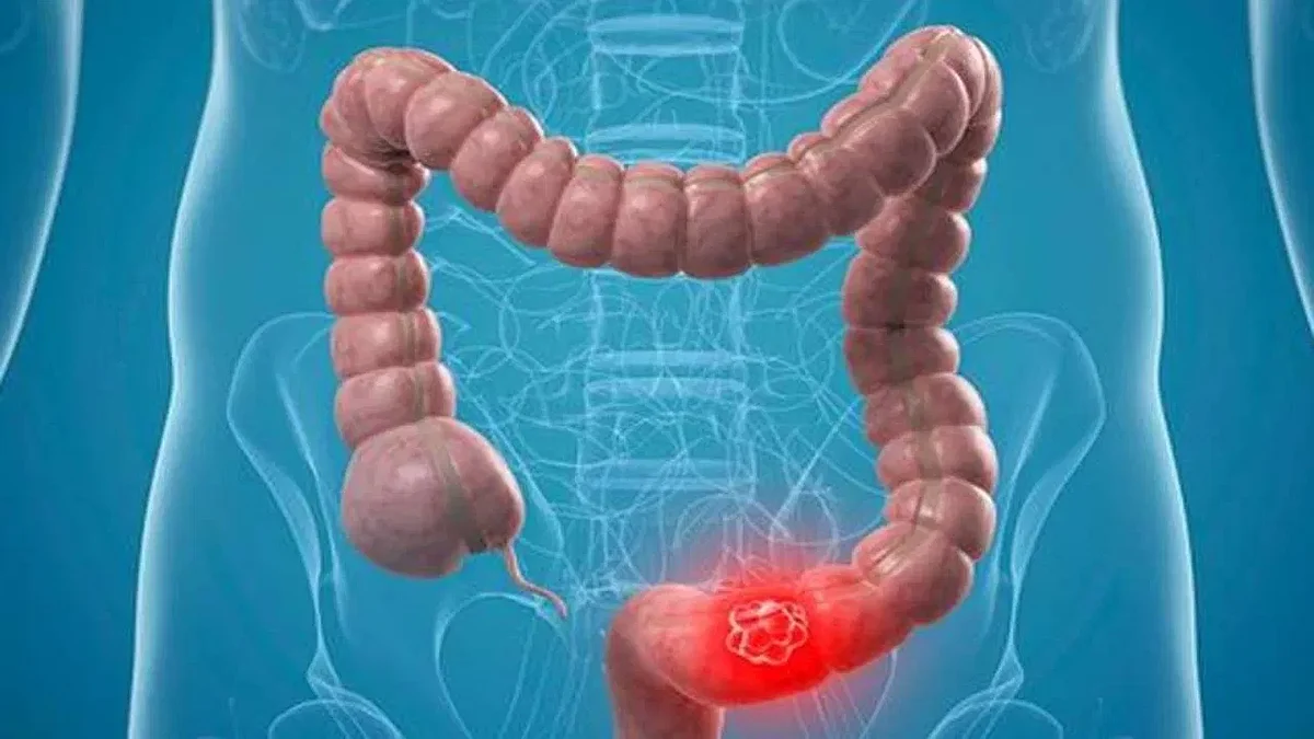 Do not ignore these Bowel cancer symtoms can be reason for big health problem