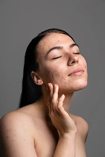 pimples