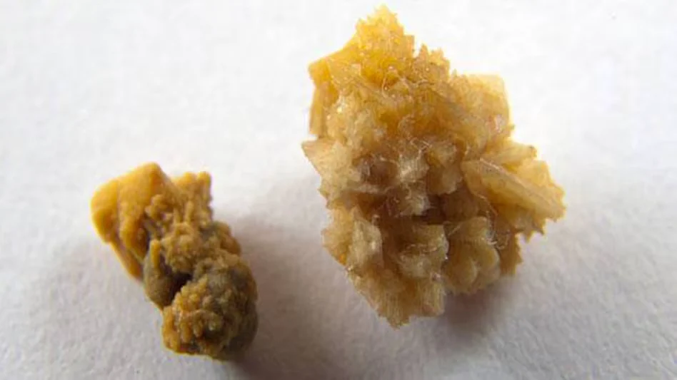 kidney stone s 650 080515035723