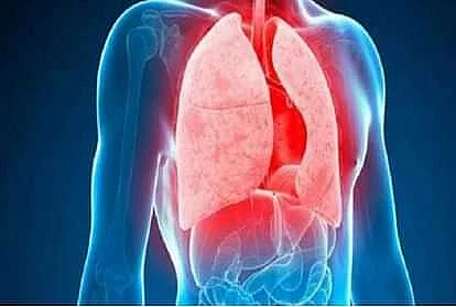 tuberculosis 1542023284