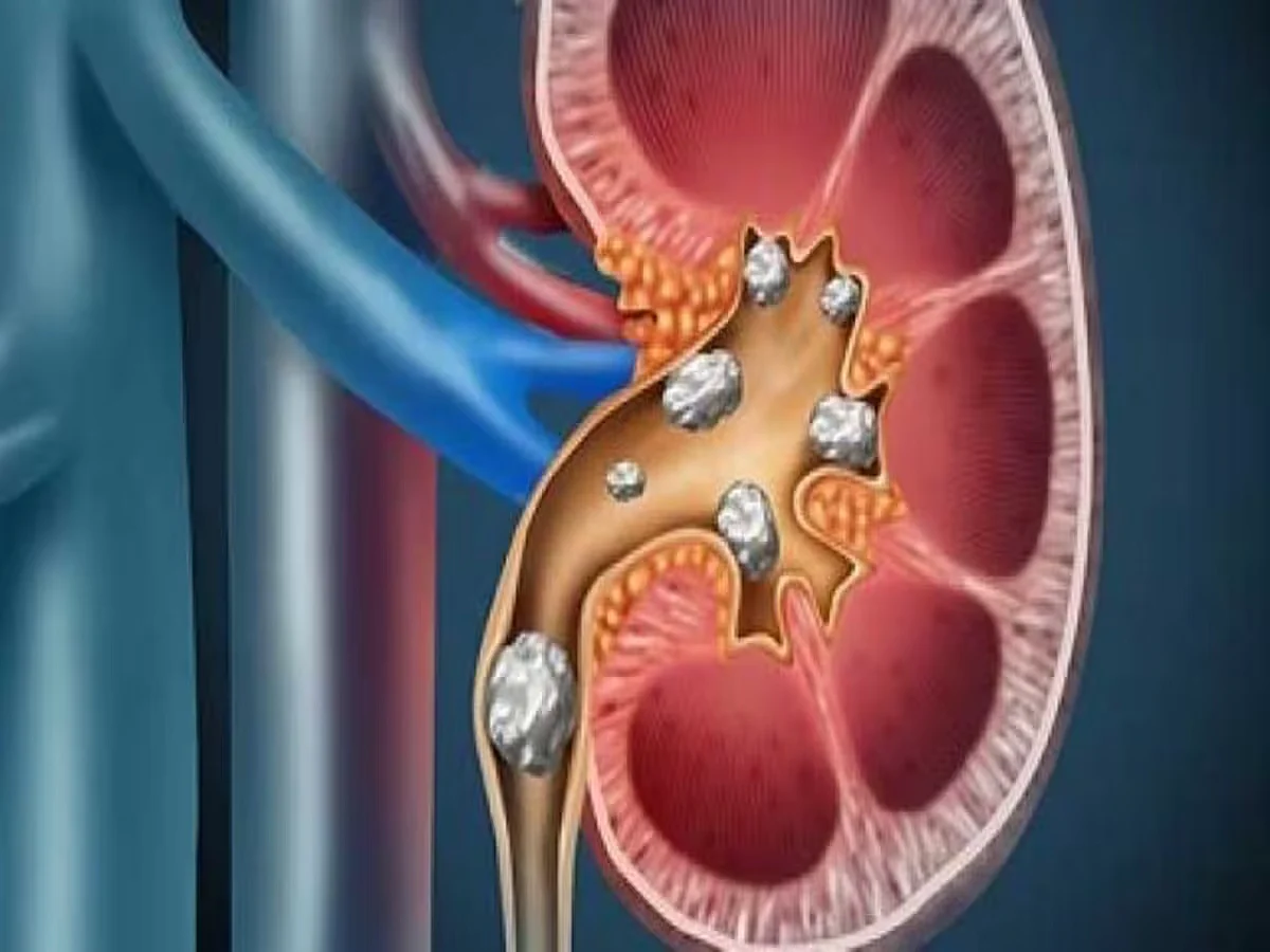 kidneystone1582357160