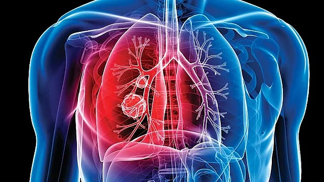 world tb day tb tb disease symptoms treatment drugs drug resistance 3