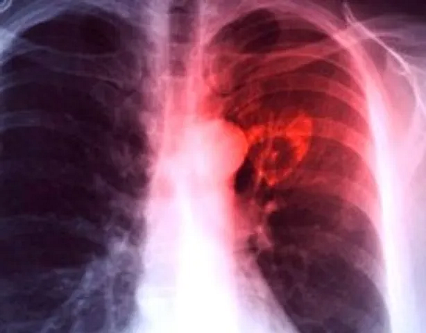 Tuberculosis3 1